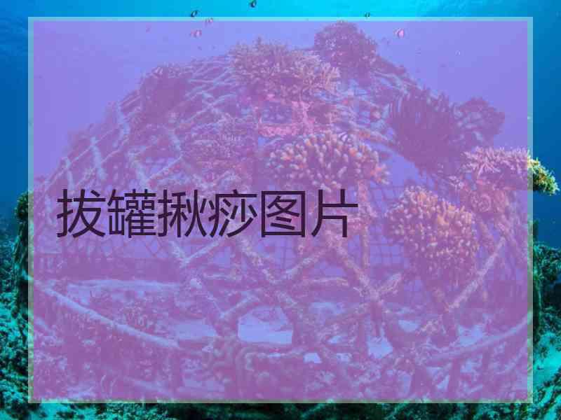 拔罐揪痧图片